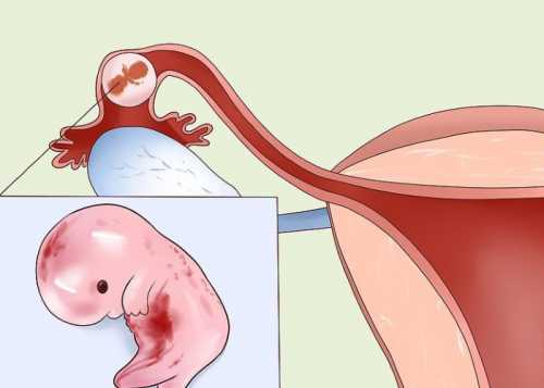 В этом случае имплантация оплодотворенной яйцеклетки происходит не в матке, а в фаллопиевой трубе