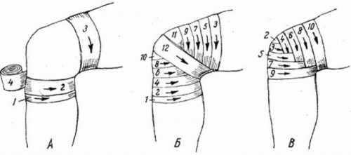 Наложение бинтовой повязки на колено