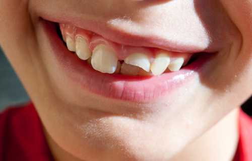 Зубы с щербинами или почерневшие предвещают успех в деле